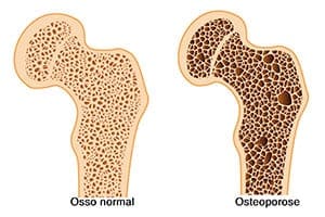 Protein und Osteoporose